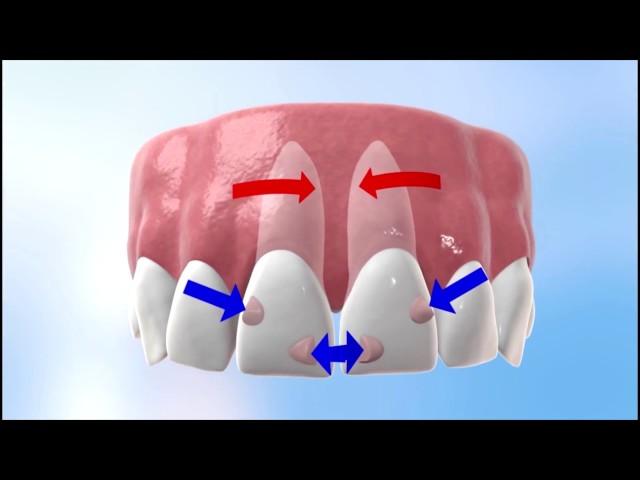 Discover how Invisalign works