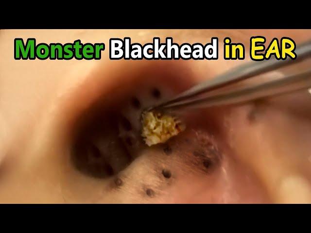 Monster Blackhead in Ear