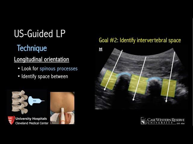 Ultrasound-Guided Lumbar Puncture