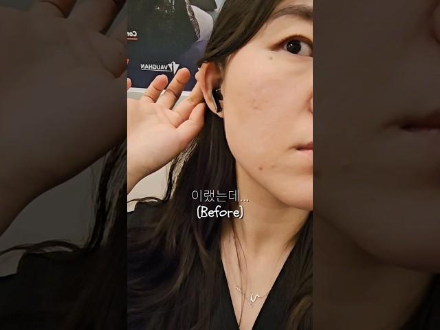 토론토에서 켈로이드 제거 수술 전 후. 깰꼼  post Keloid scar removal surgery