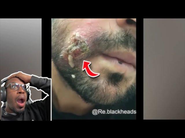 HE NEEDS TO SEE A DOCTOR ABOUT THIS CYST! | CRAZY CYST PIMPLE POPPING