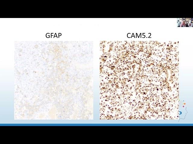 AANP Teaching Rounds - October 25, 2023 - DNA Methylation and Brain Tumors