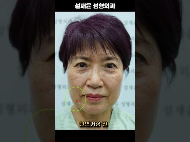 안면거상 10일 차에 회복정도 ? 경과를 체크해봤습니다! #korean #리프팅효과 #skincare #안면거상