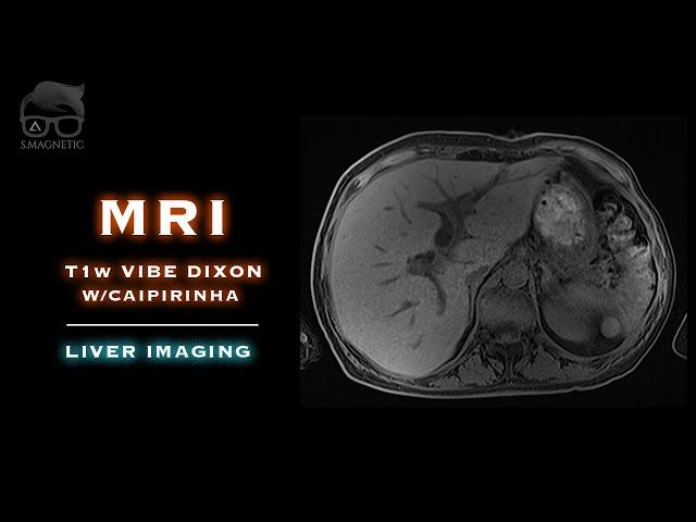 MRI – T1w VIBE Dixon w/CAIPIRINHA – Liver Imaging