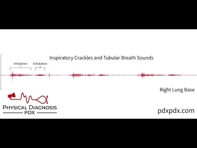 The Lung Sounds of Pneumonia