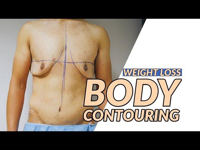 Body Contouring with Dr.Dadvand