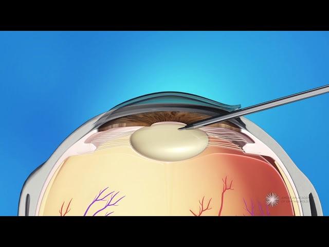 Phacoemulsification Cataract Surgery