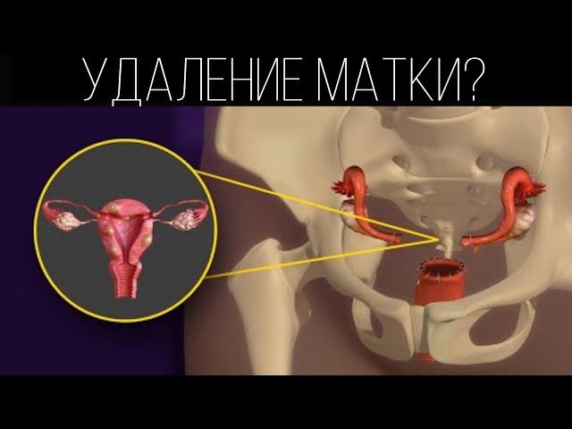 Как удаляют матку? Гистерэктомия | ПОЛЕЗНЫЙ ЮТУБ