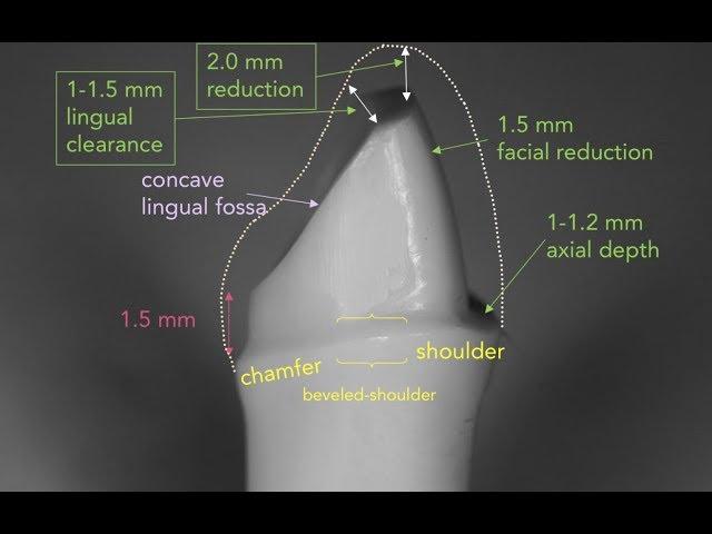 Anterior PFM Preparation | Dr. Richard Stevenson