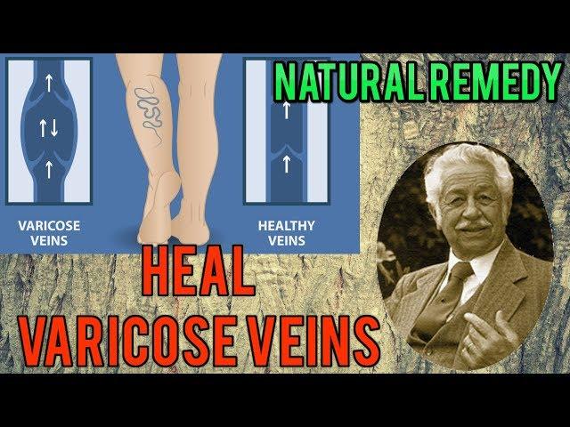 Natural Home Remedy For Varicose Veins | Dr John Christopher