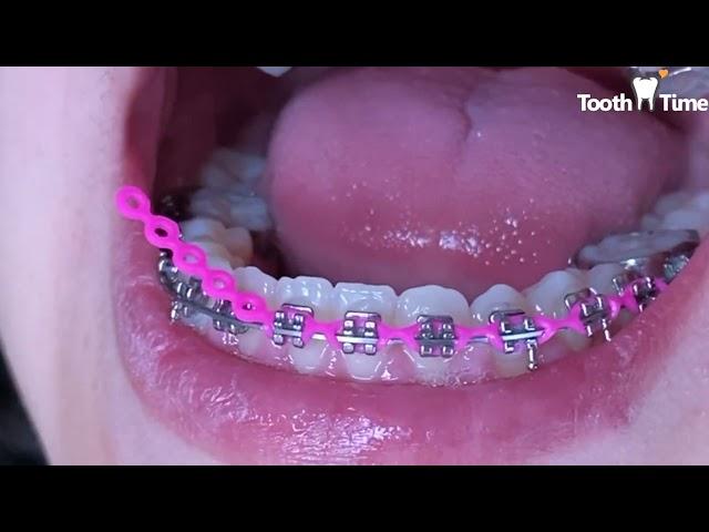 Braces checkups - Power chains - 16 months with braces - Tooth Time Family Dentistry