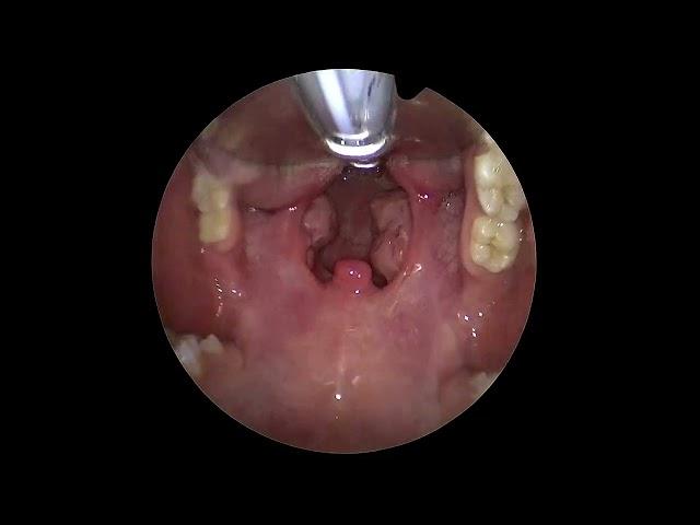 The Throat Exposure For Tonsillectomy Surgery