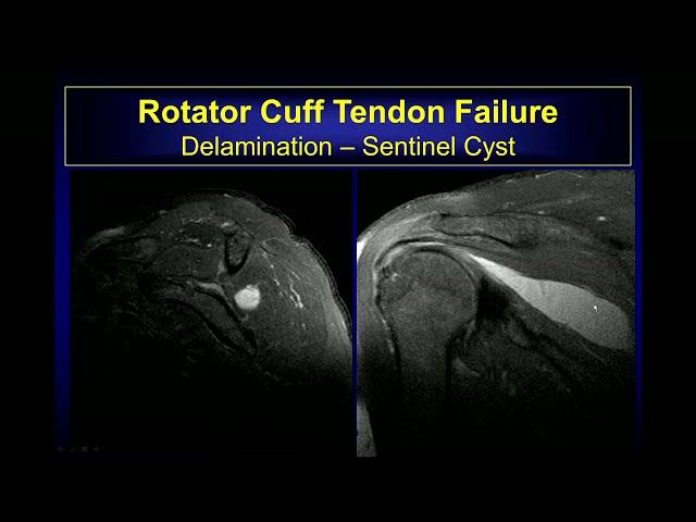 Imaging findings of Rotator cuff