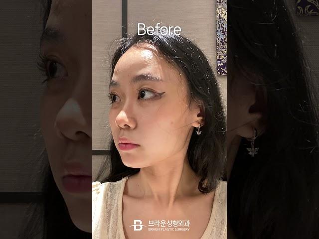 최애가 되... #안면윤곽 #안면거상 #코수술 #코성형 #이마 #성형후기 #성형전후
