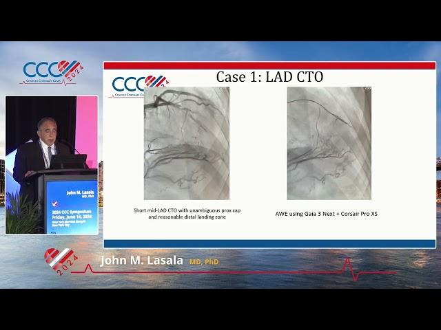 John M  Lasala, MD, PhD   Atherectomy is a Must! Severely Calcified Lesions