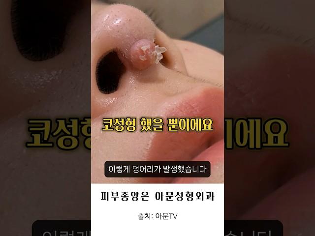 병원 가세요! (코성형 부작용 이물육아종 코기둥 비주 낭종 병원 성형외과 rhinoplasty nose foreign body granuloma seoul korea)[아문TV]