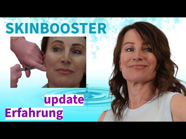 SKINBOOSTER - WÜRDE ICH ES NOCH EINMAL MACHEN ?