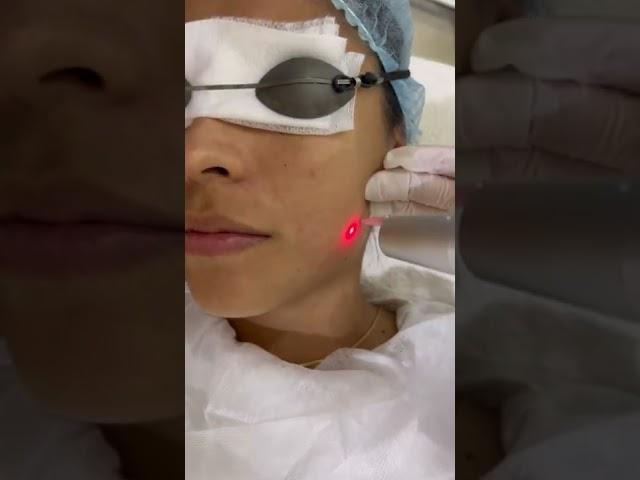 Depigmenting Laser Facial