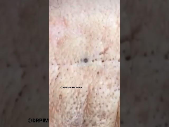 Firefighter Blackheads ‍ | Dr. Pimple Popper #drpimplepopper #shorts #pimple #blackheads