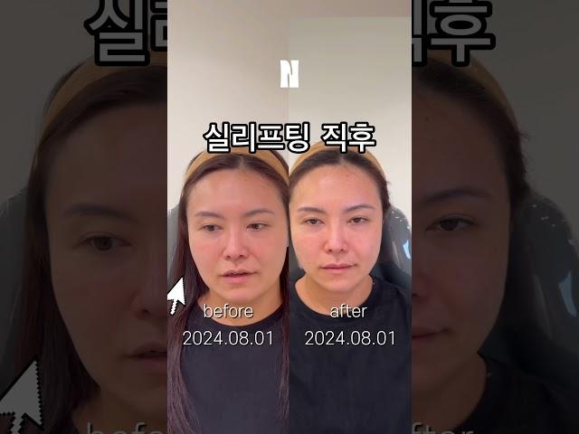 땅콩형 얼굴 하루만에 해결하는법