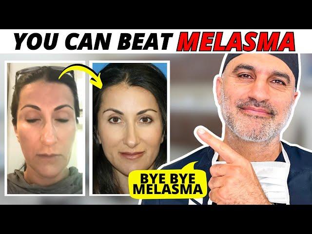 How Dr. Amir Karam treated his wife's Melasma AT HOME! Step by Step!