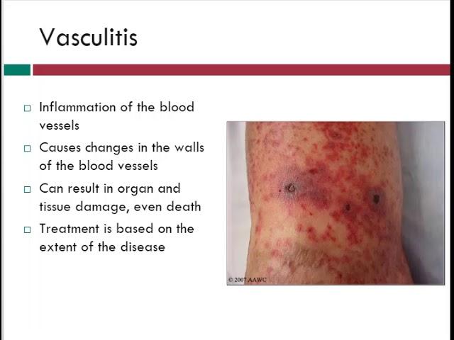 Vasculitis | Info About Vein Problems | WoundEducators.com