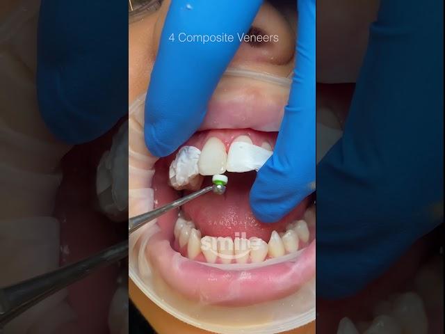 4 Composite Veneers #shorts