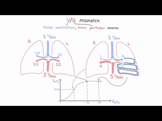 V-Q mismatch