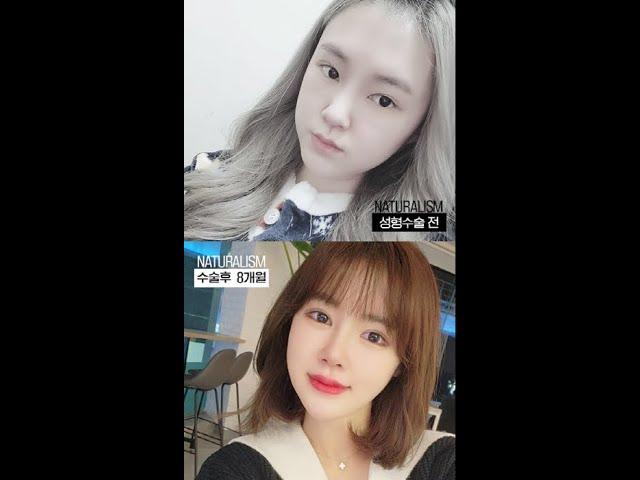 자연주의성형외과 눈재수술+코성형+얼굴지방이식 수술 전후영상