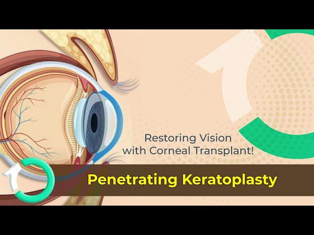 Penetrating Keratoplasty: Full-Thickness Corneal Transplant Explained | One Clinic Istanbul