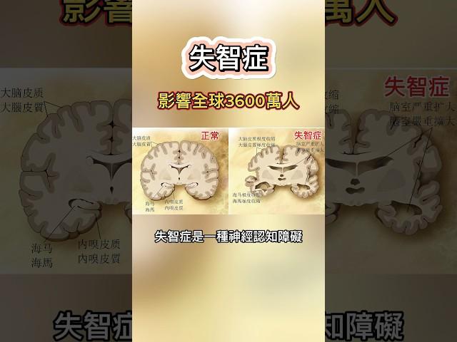 失智症 #腦部 #神經 #老化 #退化 #思考 #記憶 #認知障礙 #情緒 #語言 #阿茲海默症 #老年人