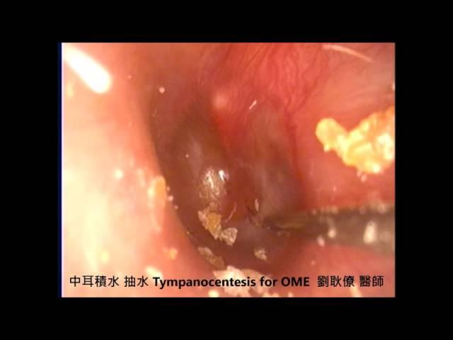 中耳積水 中耳炎 抽水  OME tympanocentesis