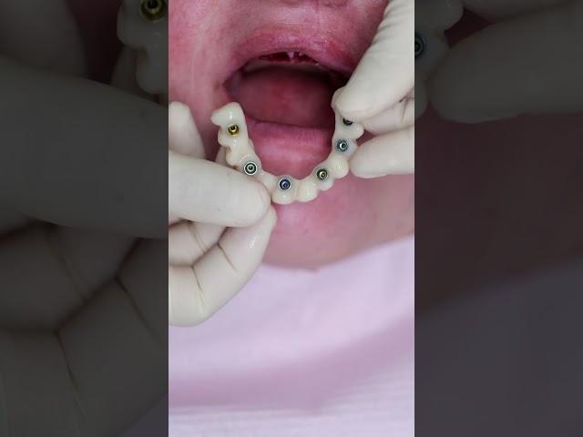 Dental implant’s All on 4 #shorts #smile  #impossible  #dentist #best #new #beautiful #shortvideo