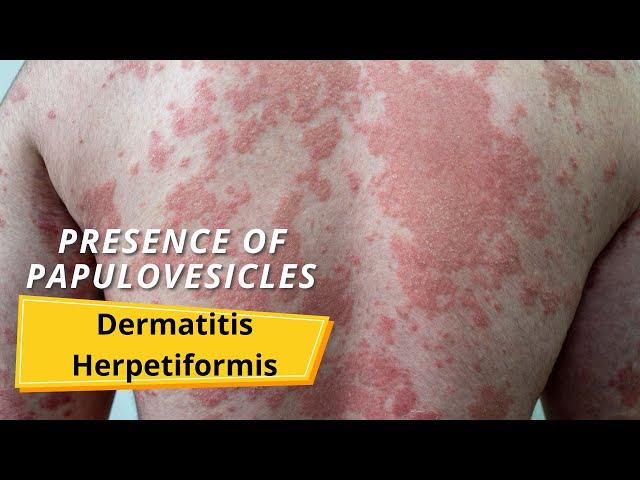 Dermatitis Herpetiformis