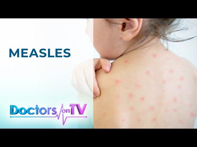 MEASLES: Cause, Symptom, Treatment, and Prevention | DOCTORS ON TV