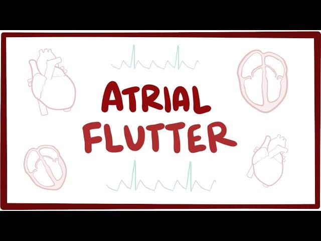 Atrial flutter - causes, symptoms, diagnosis, treatment, pathology