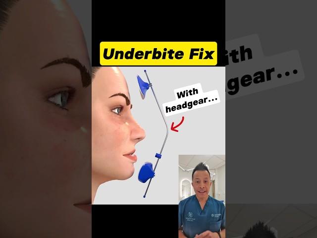 Fixing an Underbite with Headgear:  Here's How It Works! #dentallan #dentist #shorts