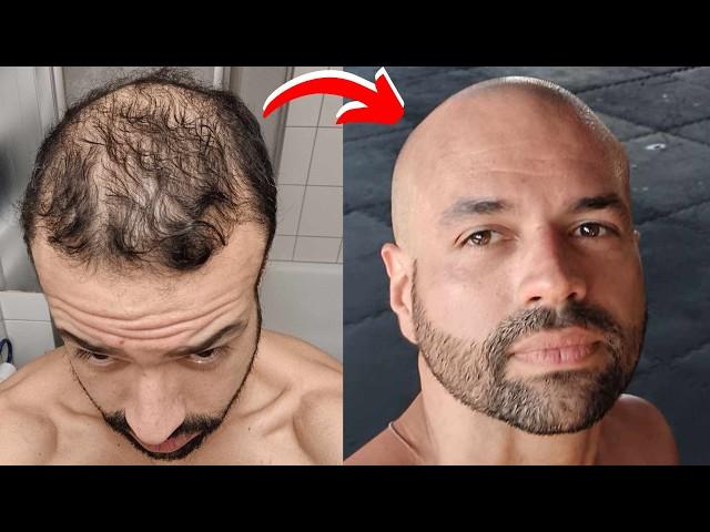 I Was So Scared Of Going Bald...Until I Did This...