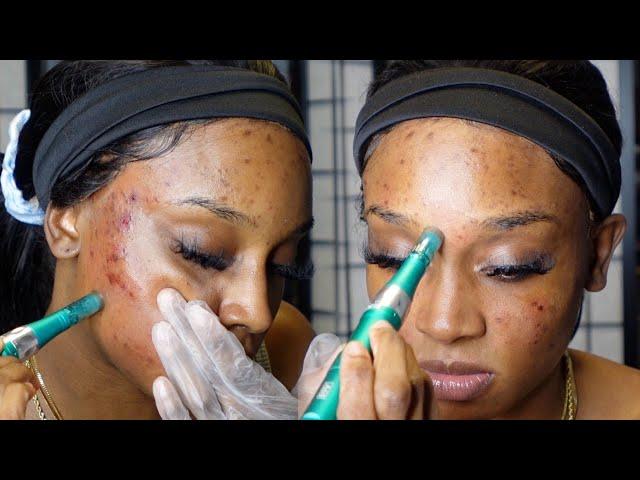 Microneedling at Home | Acne Scars, Dark Spots, Hyperpigmentation ft. Dr Pen A6S