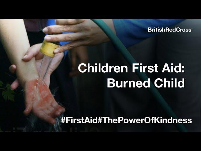 Child First Aid - Helping a child with a burn