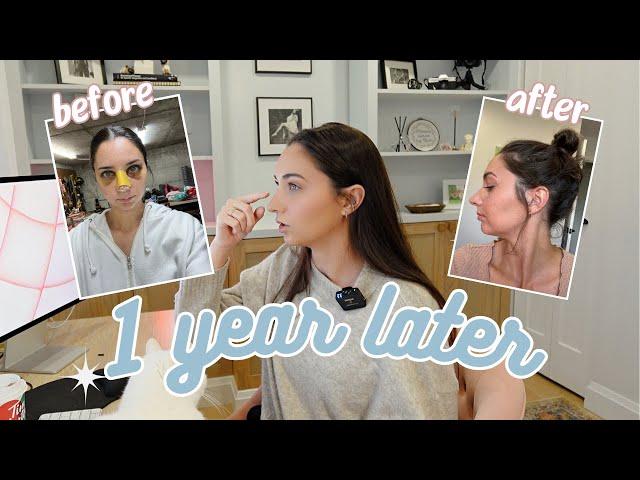 The Truth About My Rhinoplasty (1 year later...)