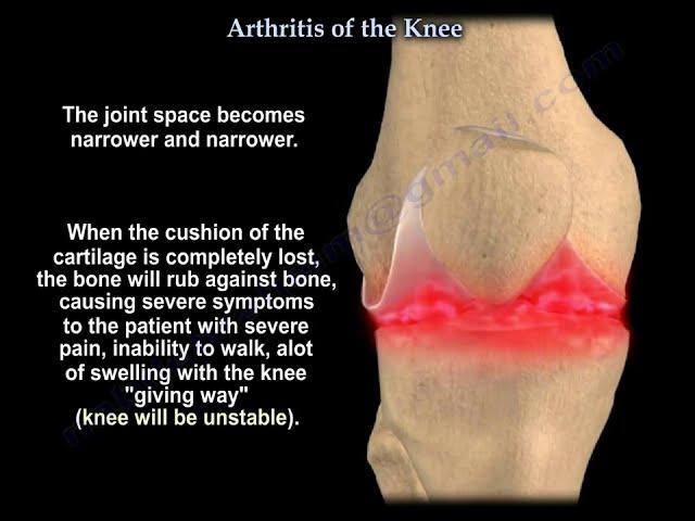 Knee arthritis symptoms and treatment - Everything You Need To Know - Dr. Nabil Ebraheim