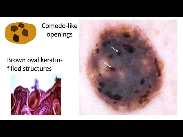 Seborrheic keratosis and solar lentigo - Dr Cristian NAVARRETE-DECHENT