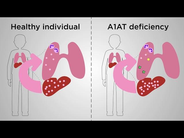 An ultimate mouse model of gene therapy for ﻿alpha-1 antitrypsin deficiency