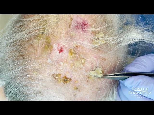 Debulking Lesions on the Scalp (Erosive Pustulosis of the Scalp)  | CONTOUR DERMATOLOGY