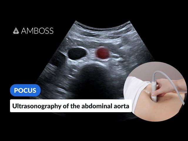 Point of Care Ultrasound of the Abdominal Aorta - AMBOSS Video