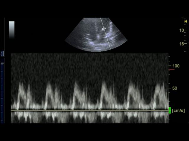 Acquiring the Mitral Inflow View with Pulse Wave Doppler for Diastolic Dysfunction Evaluation