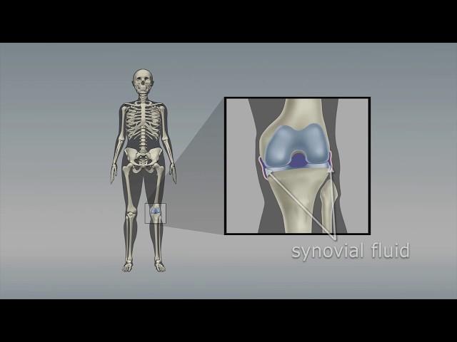 Osteoarthritis of the knee: Choosing the right pain medicine