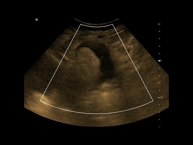 Complex Adnexal Mass - Dermoid Cyst || Ultrasound || Case 23