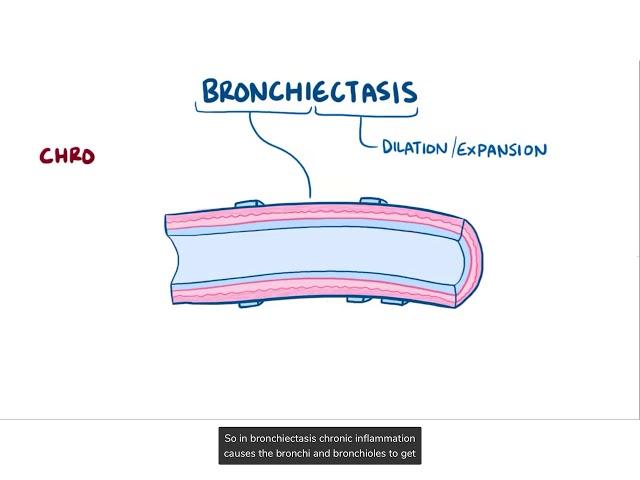 Bronchiectasis